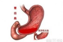 胃出血可以吃胜瓜吗,胃出血患者适宜食用胜瓜的饮食建议