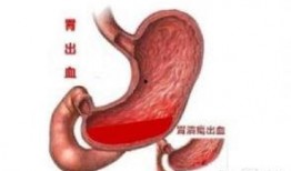 胃出血可以吃胜瓜吗,胃出血患者适宜食用胜瓜的饮食建议